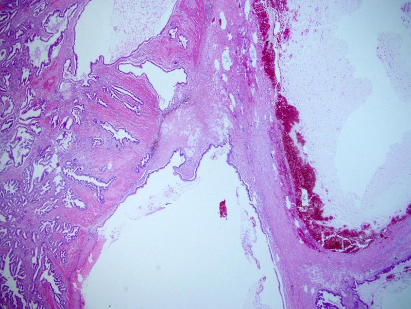 장형하 외: 점액 폭포를 보이는 점막하 종양 형태의 위 점액 선암 1예 종양 형태의 종괴가 관찰되었으며, 종괴의 표면 여러 군데에서 점액이 폭포처럼 다발성으로 분비되고 있었 다(Fig. 1B, 1C).