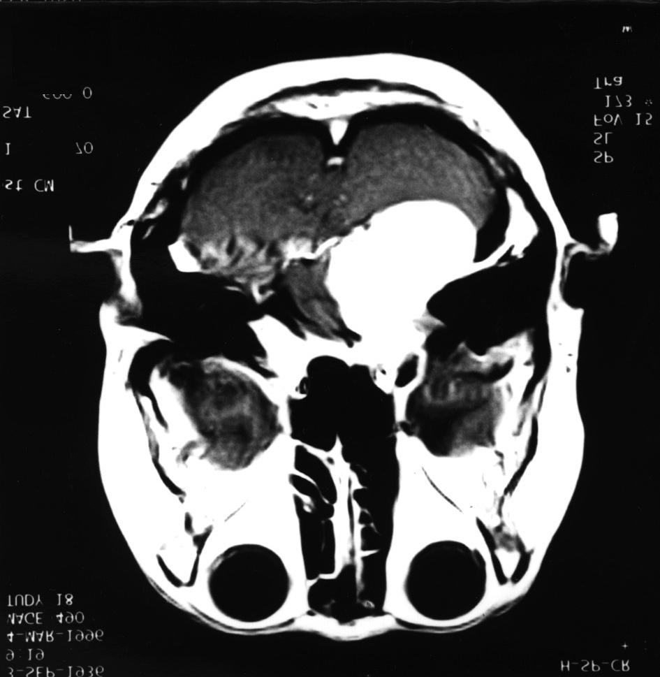 거대 소뇌교각종양 로 호전되었다. 병리조직검사상 청신경초종으로 확진되었다. 의 조영증강이 잘 되는 종양이 좌측 소뇌교각부에서 관찰 되었다(Fig. 1).