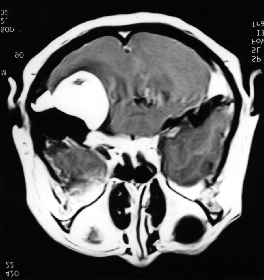 음성이었다(Table 1). 뇌 MRI상 5 cm 크기 부를 노출시켰다. 후두개 경막을 크게 열자 유양동으로 밀 B C D Fig. 1. Preoperative postgadolinium T1 weighted axial image.