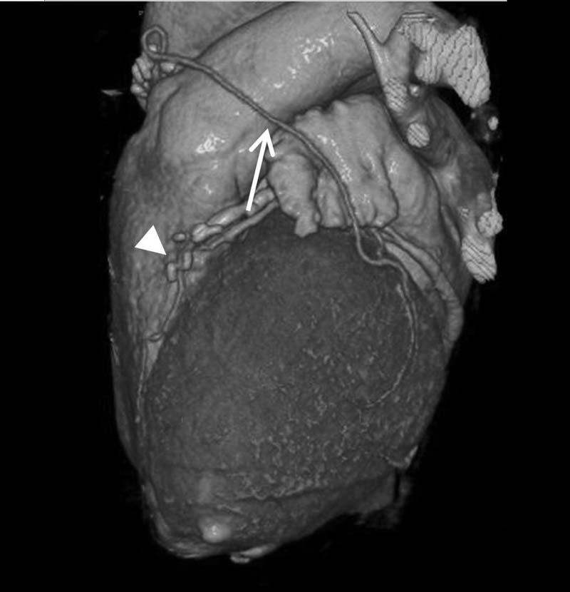 MDCT () and conventional angiogram ().