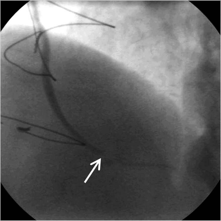 portion of saphenous vein graft (arrow), which is confirmed at