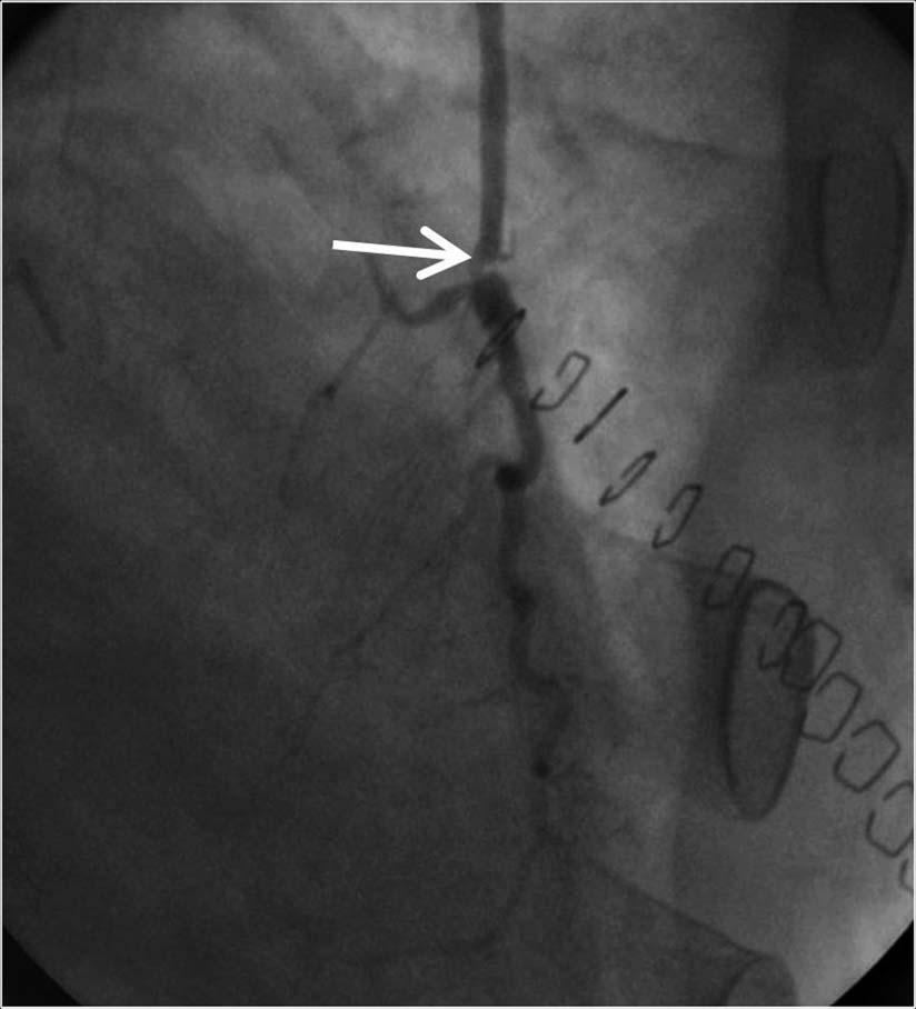 Oblique MDCT image () shows good opacification of left internal mammary artery graft (arrow)
