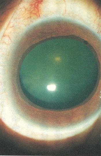 2. 당뇨병과녹내장 (Glaucoma) 1) 치료약물 베타차단제 탄산탈수효소억제제 ( 방수생산을억제 ) methazolamide,