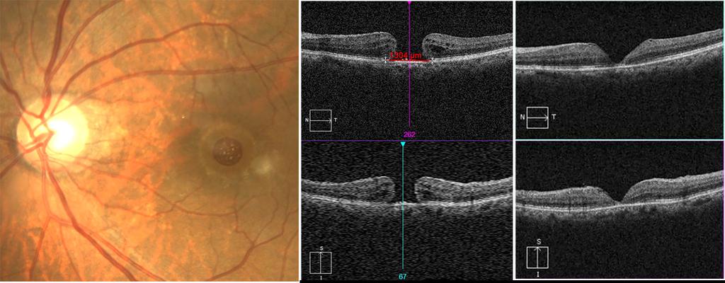 - 대한안과학회지 2018 년제 59 권제 5 호 - Figure 4. A case of full thickness macular hole in 75-year-old-female.