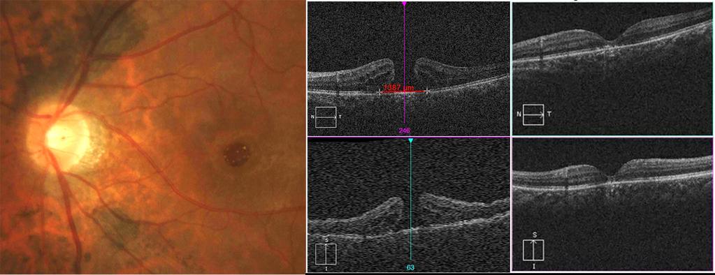 7 days after surgery, type 1 closure of hole was detected in OCT scan image (C). logmar vision improved from 1.60 to 1.00. Figure 5. A case of full thickness macular hole in 38-year-old-male.