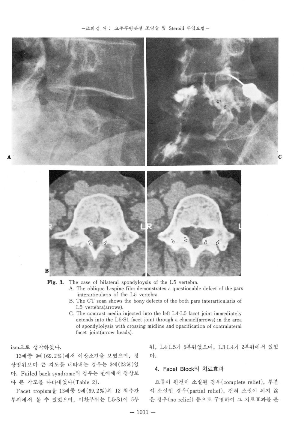 - 초희경외 : 요추후방관절조영술및 Steroid 주입요업 - A Fig. 3. The case of bilateral spondyloysis of the L5 vertebra A. The oblique L.
