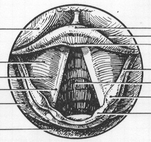 내시경으로관찰한 hypopharyx 와 larynx - 화면좌측 left pyriform sinus 로진입 tongue vestibular fold ventricle vocal fold piriform recess posterior