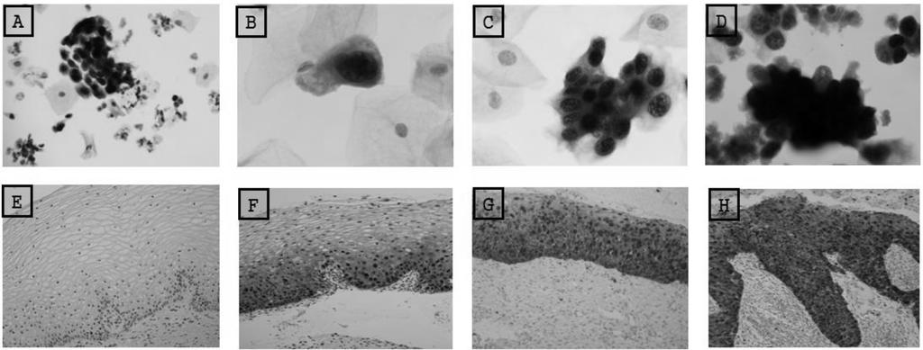 134 Mi Hee Sung, et al. p16 INK4a /Ki-67 Dual Immunostaining in Liquid-based Cytology detection reagent 1을이용하여 alkaline phosphatase-conjugated antibody 와 30분반응하였다.