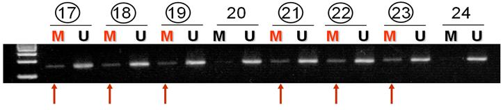 - 대한내과학회지 : 제 78 권제 3 호통권제 595 호 2010 - Figure 1. Representative data for methylation-specific PCR for CpG islands of the p16 INK4a gene promoter in papillary thyroid cancer.