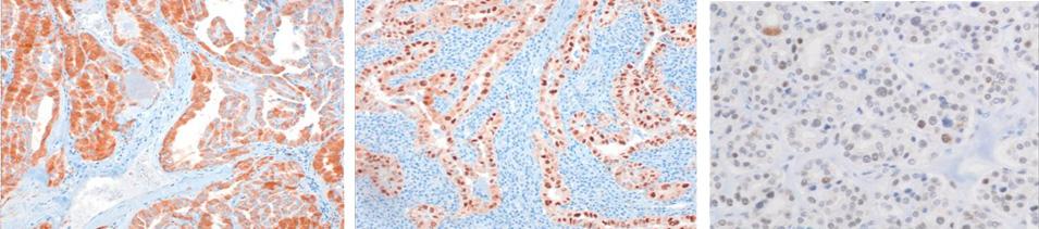 Typical images of p16 INK4a, cyclin D1 and prb expression in papillary cancer by immunohistochemistry ( 100).