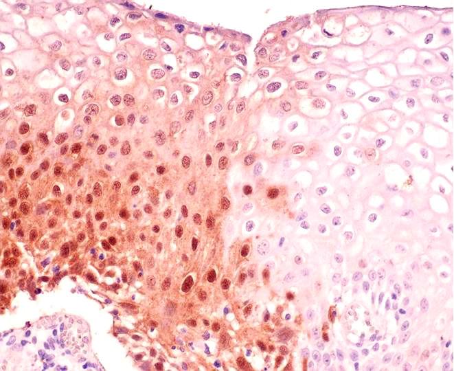 90% positive for p16 INK4a immunohistochemical staining in invasive cervical cancers. 고 찰 HPV 감염은자궁경부암의발생에가장큰원인으로 알려져있다. HPV 감염에의한자궁경부의암화과정 은 HPV 의 E6 및 E7 단백이세포조절주기단백의기능 을저하함으로생겨남이알려져있다.
