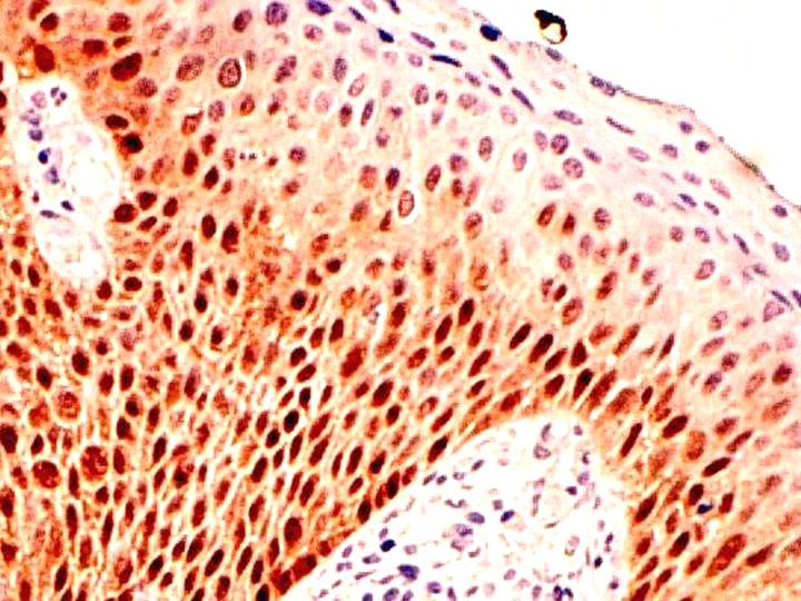 10%), 자궁경부상피내종양의이형세포의경우뚜렷 이염색되어자궁경부상피내종양진단의재현성 (reproducibility) 을증가시키는객관적인표지로서사 용될수있을것으로사료된다. 본연구에서는고위험군 HPV감염이있는경우 p16 INK4a 이상발현이증가하였으며이는이전연구결과 들과일치한다.