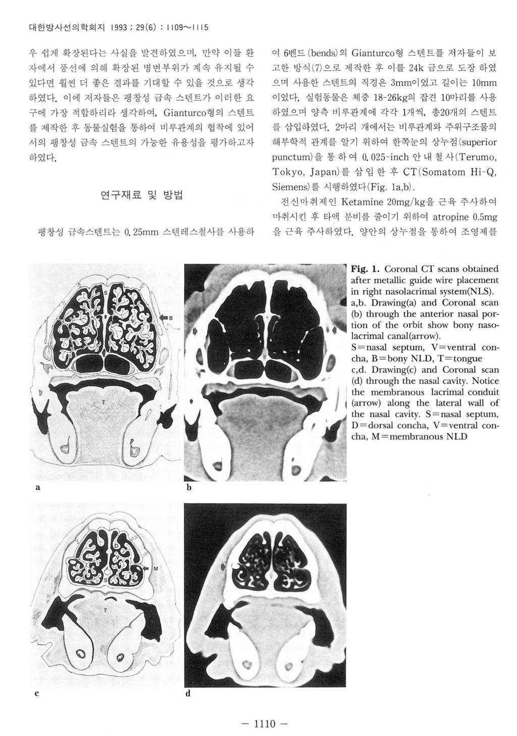 대한방사선의학회지 1993; 29 (6) : I I09~1115 우쉽게확장된다는사실을발견하였으며, 만약이들환자에서풍선에의해확장된병변부위가계속유지될수있다면훨씬더좋은결과를기대할수있을것으로생각하였다.