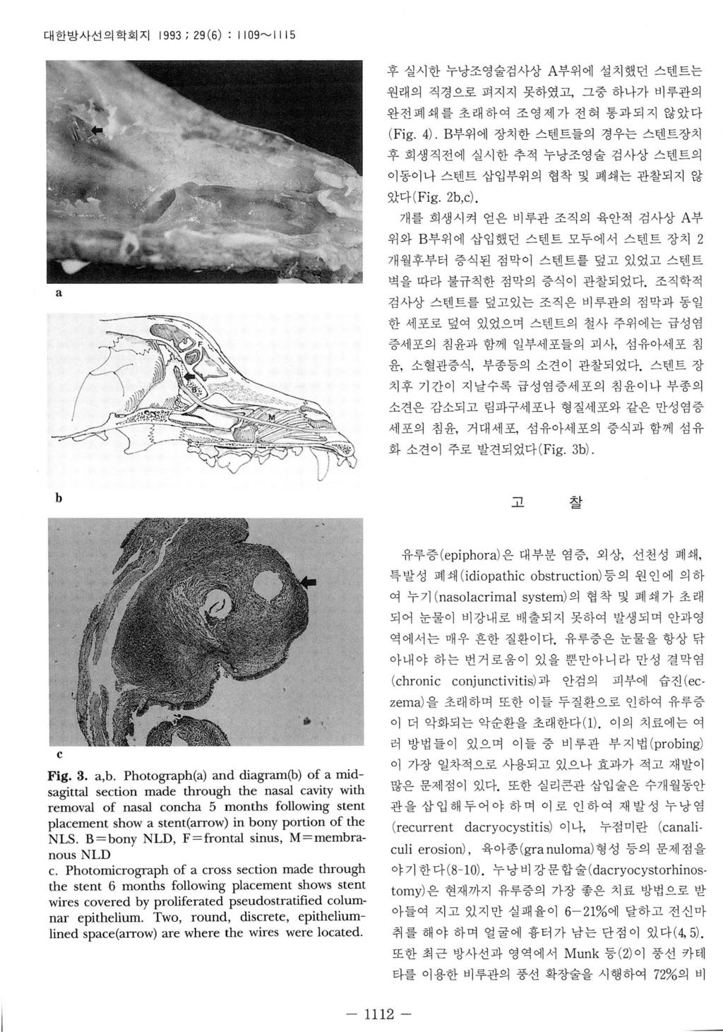 대한방사선의학회지 1993; 29(6) : II09 ~1115 후실시한누낭조영술검사상 A 부위에설치했던스텐트는 원래의직경으로펴지지못하였고, 그중하나가비루관의 완전폐쇄를초래하여조영제가전혀통과되지않았다 (Fig. 4). B부위에장치한스댄트들의경우는스텐트장치후희생직전에실시한추적누낭조영술검사상스텐트의이동이나스텐트삽입부위의협착및폐쇄는관찰되지않았다 ( Fig.