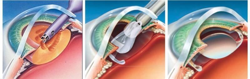 5) Operative Terms posterior chamber lens