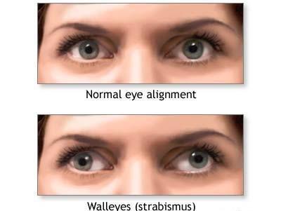 5) Operative Terms correction of strabismus 사시교정눈의근육 (ocular muscles) 을힘줄절개술 (tenotomy)