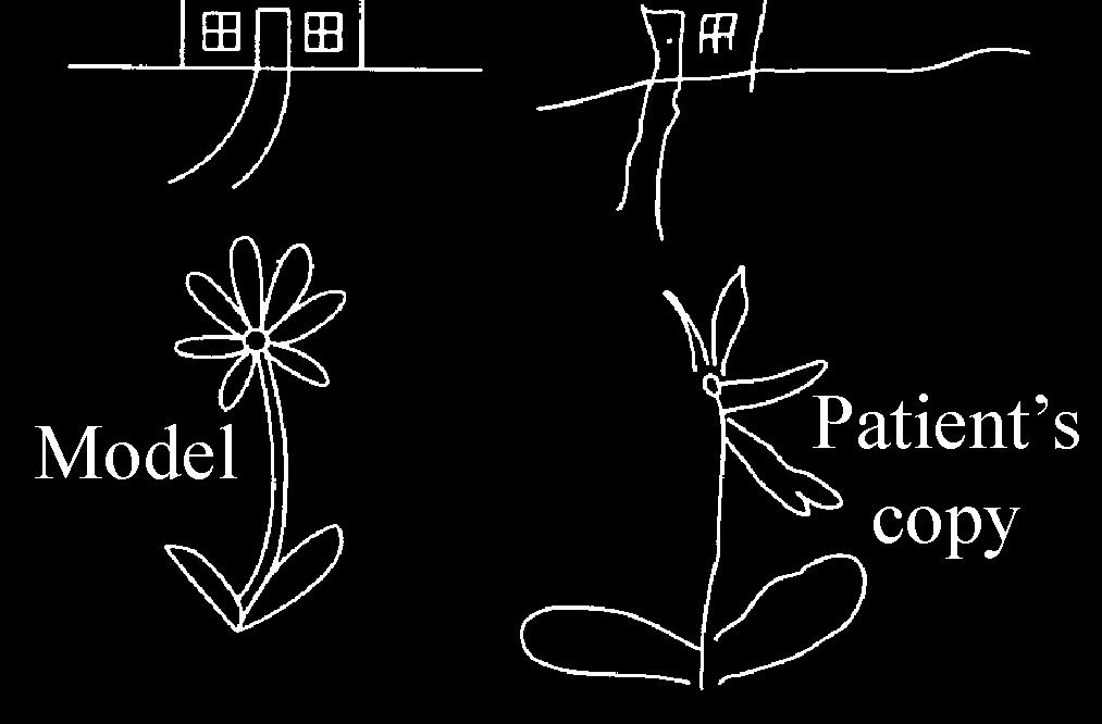 얼굴실인증 ), cortical blindness( 피질맹 ) Temporal lobe 안쪽손상 : 기억력장애 Thalamus infarction: