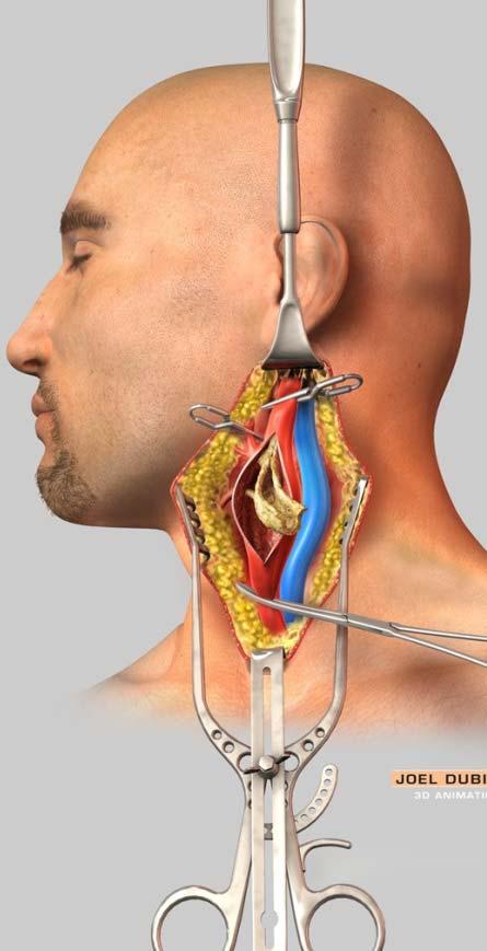 jpg 2 일과성허혈성발작 (Transient Ischemic Attack : TIA) 일과성허혈증 (TIA) 발견을위한대상자교육지침 다음증상이있으면의사를방문하십시오.