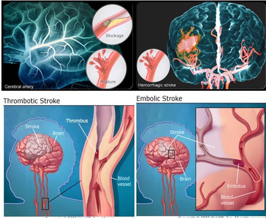 허혈성뇌졸중 혈전성뇌졸중 (Thrombotic stroke) 색전성뇌졸중 (Embolic stroke) 출처 :