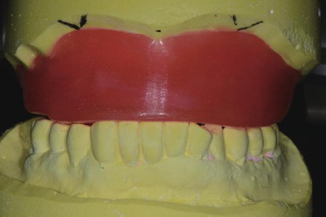 Prosthetic rehabilitation using an obturator in a fully edentulous patient who had partial
