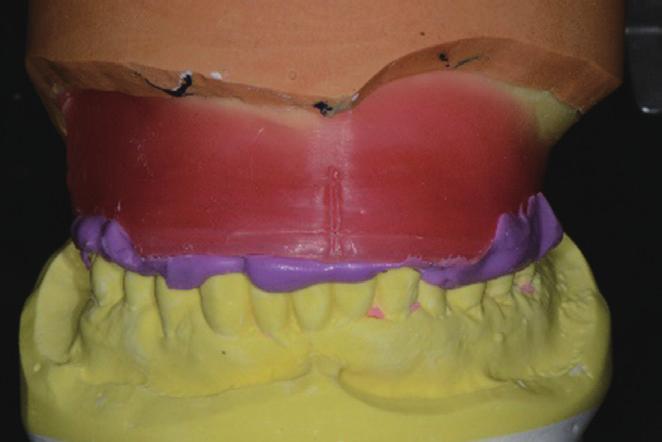 Prosthetic rehabilitation using an obturator in a fully edentulous patient who had partial maxillectomy C Fig. 6.