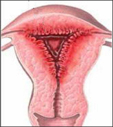 I. 일반적월경장애 6 장. 생식기계문제 D. 자궁내막증 (Endometriosis) d.