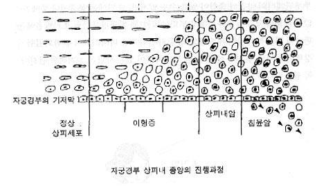 C. 악성종양 11 장. 생식기관의구조적장애와종양 3-1-1. 이형성증 (dysplasia) a. 정의 : 비정상적세포의형성또는증식성숙한세포의크기, 모양구성의변화 b.