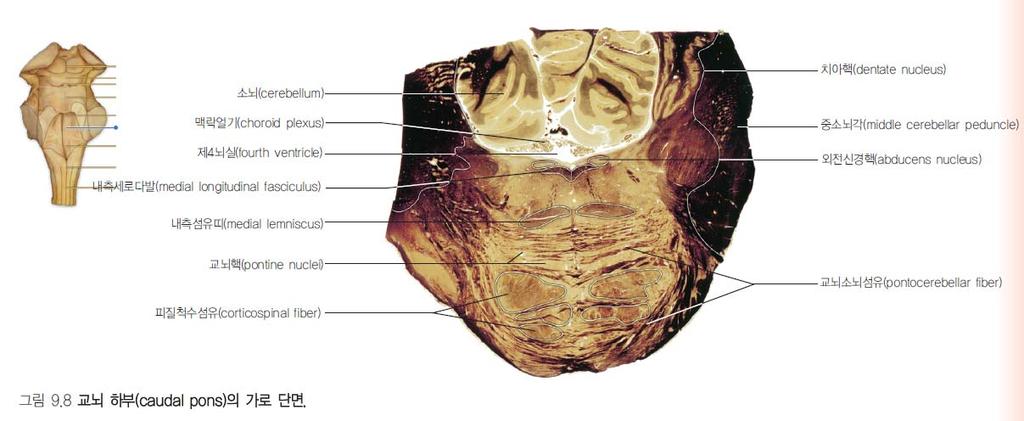 Pons( 교뇌, 다리뇌 ) ventral portion: basal portion dorsal portion: tegmentum( 피개 ) 경계 : medial lemniscus Trapezoid body( 능형섬유체, 마름섬유체 ) 청각전달하는가로방향신경섬유들로구성 cochlear nuclei -- trapezoid body( 반대쪽으로 ) --