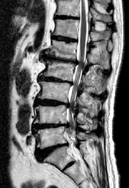 유시현 Burning pain after intrathecal steroid 53 Fig. 1. T2 weighted image of lumbar MRI. (A) Sagittal view showed L2-4 diffuse bulging disc with thecal sac indentation and retrolisthesis in L2 on L3.