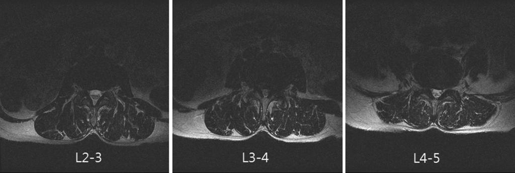 4) 신경학적검사에서근력및감각의저하는보이지않았으며단순방사선검사에서 2-3요추후방전위와 3-4요추간전방전위증의소견이관찰되며 (Fig. 1) MRI에서 2-3, 3-4, 4-5요추간척추관협착증의소견이관찰되었다 (Fig. 2).