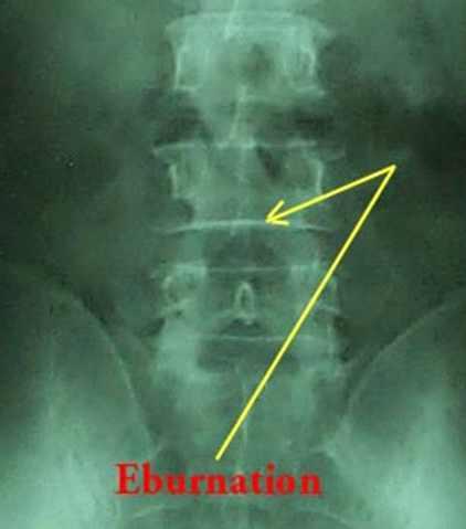 (4) Eburnation ( 가 ) End plates