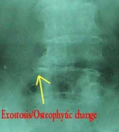 (10) Exostosis = bone spur ( 가 ) 퇴행성으로