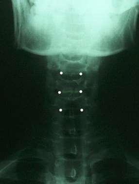 6) 영상분석가 ) 경추 (1) AP-Cervical ( 가 ) Listing line 또는 Base Line 1 추체의 body 하단에서좌우의모서리에서각각의점을찍는다.