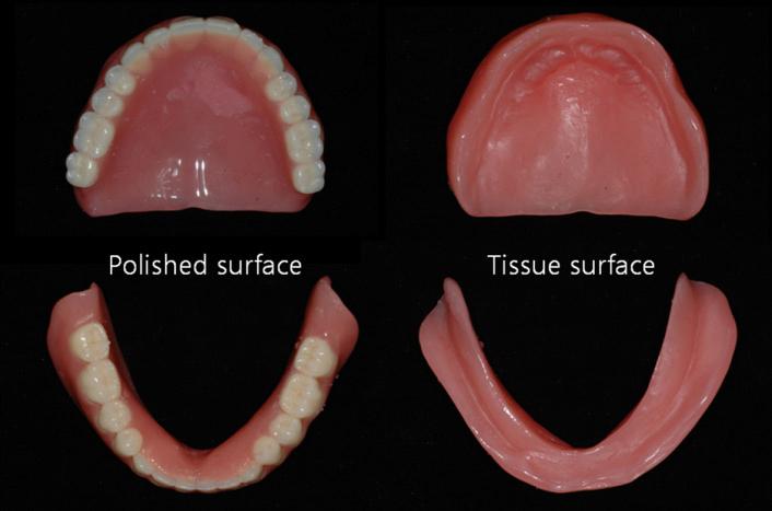 의치장착전, 구의치장착시와새로운의치장착후환자의측모를살펴보면심미적으로많은개선이이루어진것을알수있다 (Fig. 9). 환자역시심미적, 기능적인면에서새로운의치에대해만족감을나타내었다. Fig. 8. Polished surface () and tissue surface () of new dentures. Fig. 6.