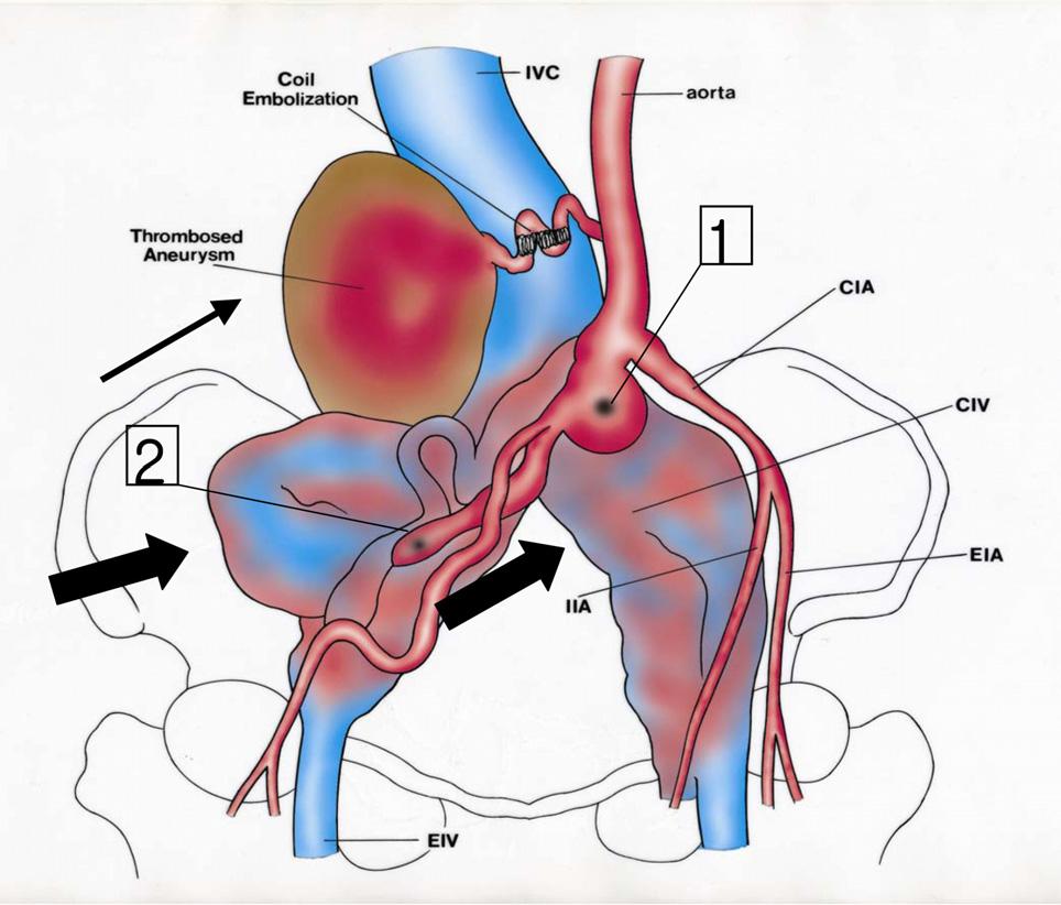 arteriovenous fistula (V) in the pelvic cavity.