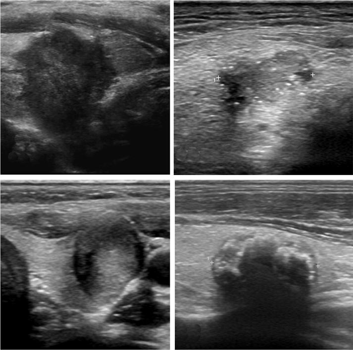 - The Korean Journal of Medicine: Vol. 77, No. 5, 2009 - 갑상선암의초음파진단갑상선초음파는갑상선결절의크기, 개수, 각결절의초음파특성및경부림프절병증에대한정보를실시간으로제공한다 8).