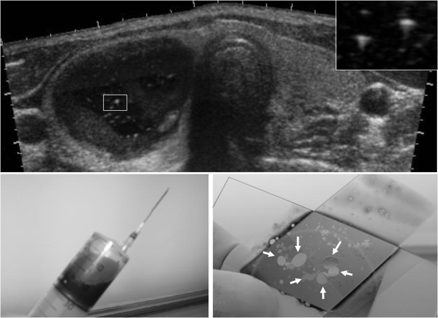 - Ho-Cheol Kang. Ultrasonographic, cytologic and genetic diagnosis of thyroid cancers - A B C Figure 2. A case of cystic colloid nodule with multiple comet-tail artifacts.