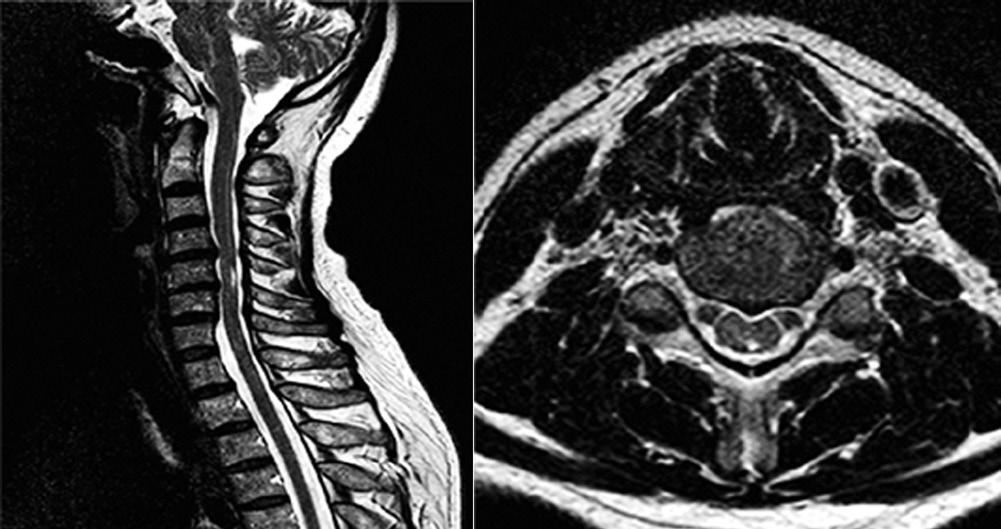 Volume 22 Number S2 November 2015 Horner s syndrome (HS) A rare and self-limiting complication of regional anesthesia in neck region such as brachial and cervical plexus blocks Epidural spread