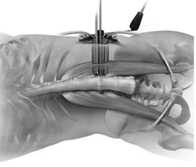 Volume 22 Number S2 November 2015 외측추체간유합술 : Direct Lateral Interbody Fusion (DLIF) 홍재영 고려대정형외과학교실 (e.g., due to crest, ribs, scoliotic collapse, etc.