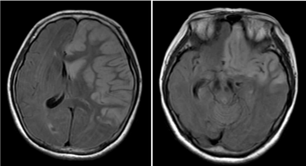 A B Figure 2. Fluid-attenuated inversion-recovery MRI at the lateral ventricles shows the shift of the septum pellucidum from the midline with effacement of the ipsilateral ventricle (A).