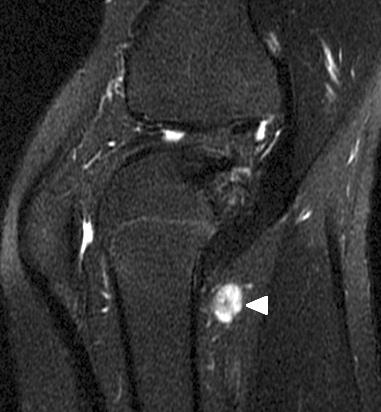 281 Glomus Tumor Causing Knee Pain Figure 4. Sagittal T2 () and axial T1 () magnetic resonance imaging findings.
