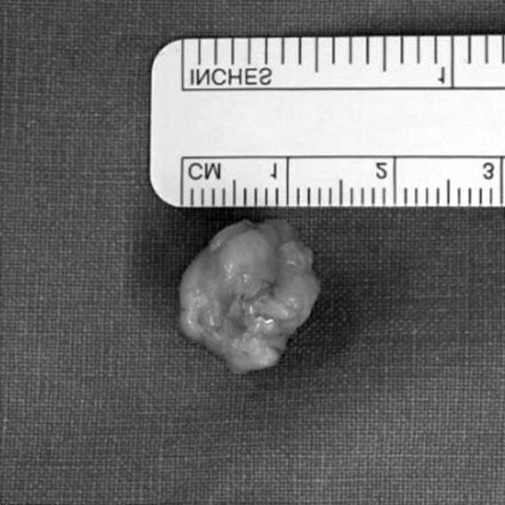 수술후좌측슬관절내부및슬와부분의통증및압통은없어졌으며수술후 6개월추시상증상의재발은없었고, 현재추시관찰중이다. 고찰 Figure 5. Gross photo of specimen shows a round-in-shape, wellencapsulated mass with a size of 1.3 1.5 1.5 cm. 2.