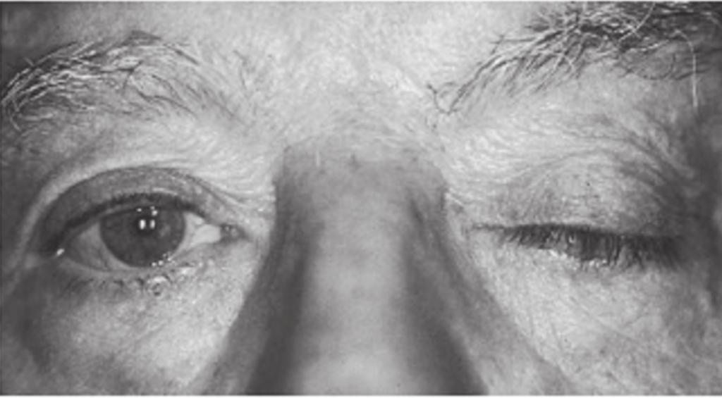 Huh YE Eye Findings in Neuro-muscular Diseases 의미를갖는다. 그럼에도근무력증환자에서동공부등 (anisocoria) 이보고된바가있고이는콜린에스터라제저해제사용시호전되었다.