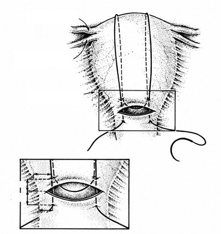 Postpartum Hemorrhage Fallopian tube Round ligament Broad ligament 3cm 3cm 4cm 3cm 2 3 4 5 6 Figure 3. Suture placement in the BLynch compression stitch for atonic uterine hemorrhage(4). 1 11.