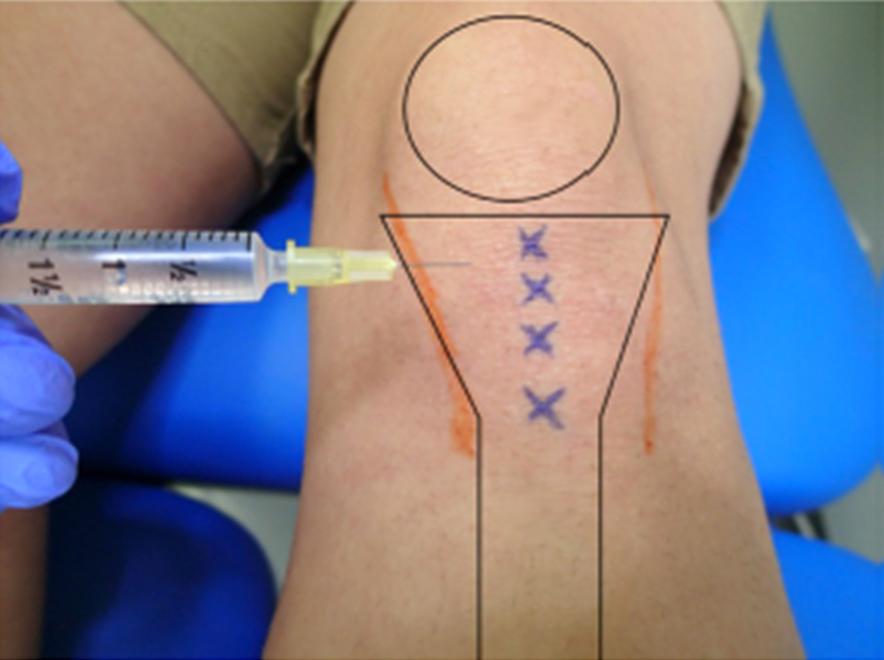 added to eccentric exercise, DPT results in faster and sustained improvement in pain and function13) DPT improves pain scores and flexion ROM14,15) No evidence of use in subacute and chronic low back