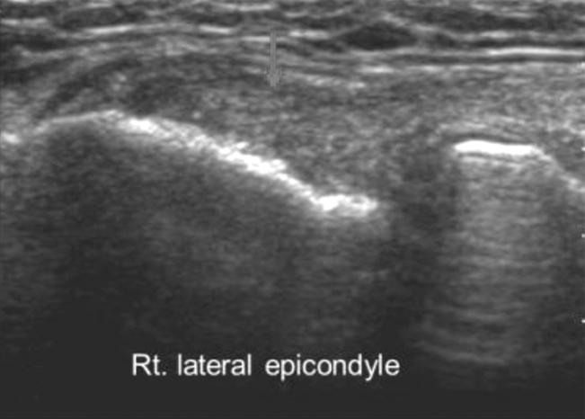 A case of successful treatment with prolotherapy in patient with lateral common extensor tendon tear (A).