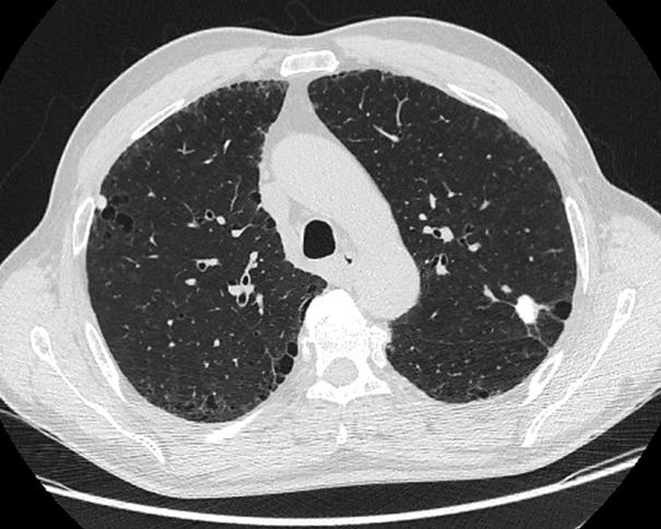 사회력 : 40년전시멘트원료배합실에서 5년간근무한 Figure 1. Posteroanterior chest radiograph shows subpleural reticular opacity in both lower lung zones and small nodular lesion in left upper lung zone.