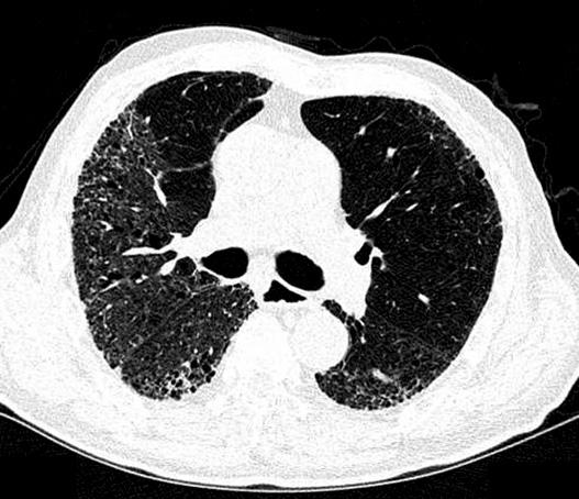 이정운외 : 기관지성폐렴환자에서경험한통상성간질성폐렴 1 예 Figure 2. High resolution computed tomography shows reticular and ground-glass opacity with honeycombing cyst in both lungs especially both lower lobes and right lung.