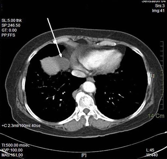 () chest radiograph shows reticular opacities in both lungs before treatment.