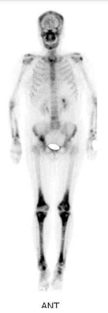 femur and both tibiae. 하행대동맥을감싸고심늑막간에위치한연조직성종괴 (Fig. 2) 및종격동에림프절들이관찰되어악성종양의전신적전이가의심되었다.